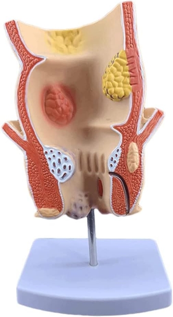 Organs Model Teaching Model Human Pathological Rectal Model Human Body Model Rectal Ulcer Organ Model Medical Anatomy Model Detachable Model