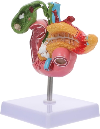 Pathological Model of Gallbladder Spleen Lesions Model Pancreatic Model Pancreas Lesions Model Duodenal Lesion Model Biology Teaching Model Gallstone Digestive System Model Pvc